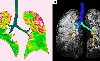 Covid-19'un akciğerlere verdiği zararı gösteren röntgen ve tomografi görüntüleri!
